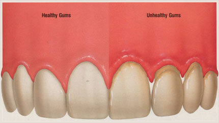 HealthyvsUnhealthyGums