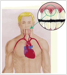 heart-disease